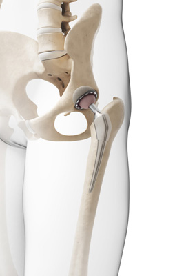 Hip Implant Failure and Product Liability Litigation