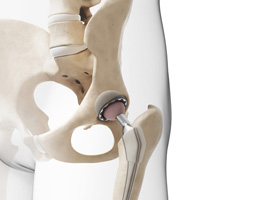 Hip Implant Failure and Product Liability Litigation