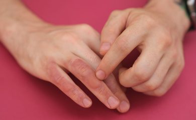 Burn Injury Lawsuit